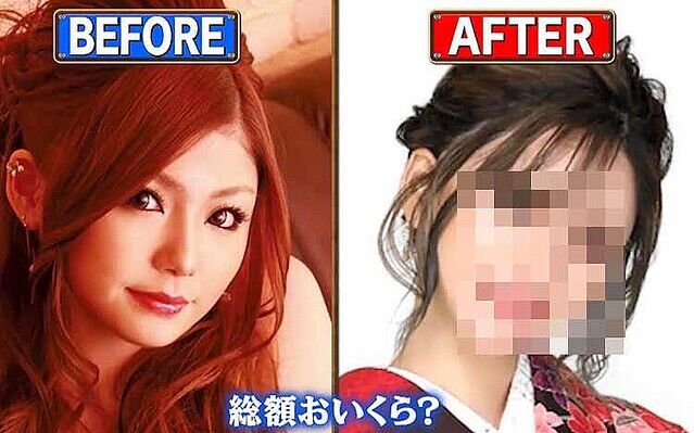 さんまもビックリ！キャバ嬢の整形事情：1000万円超えがザクザク、感染症で手術費が爆上がり！