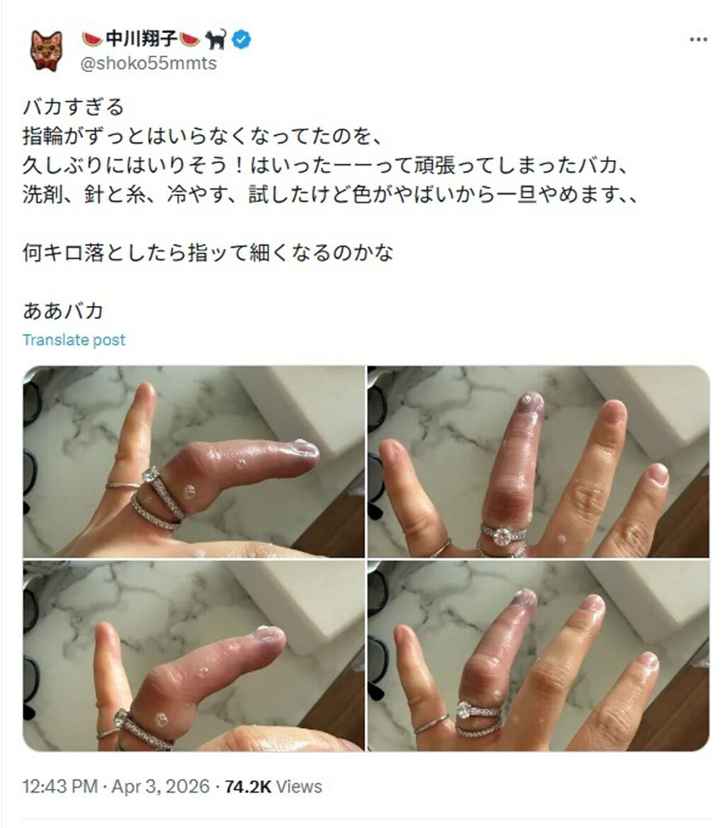 中川翔子「指輪が抜けない」パンパンに腫れた指の写真をアップし大炎上「早く病院行けばいいのに」