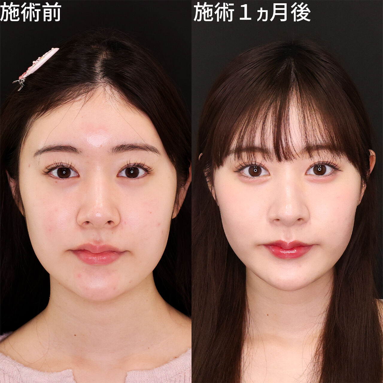 【整形】元NGT48メンバーが500万整形の箇所を赤裸々告白「人生早めに可愛くなってうれしい」