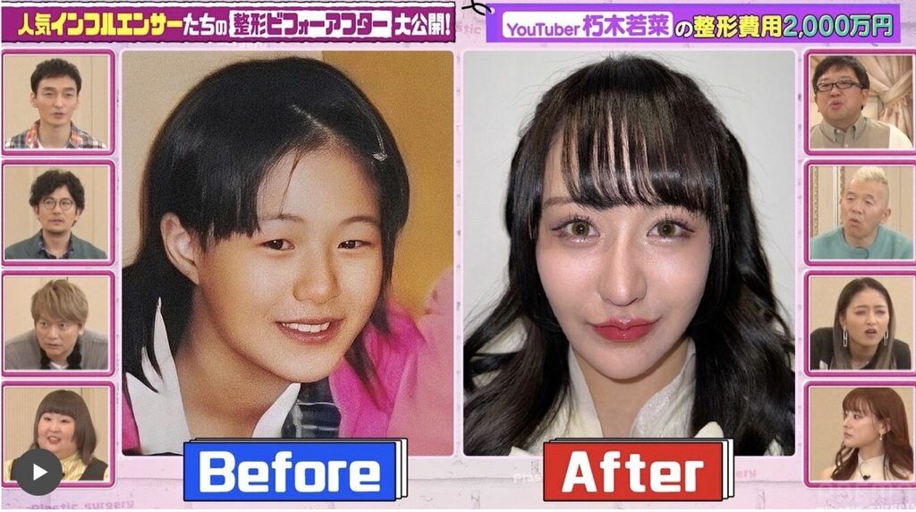 【画像】現代の整形、ここまで変わるｗｗｗｗｗｗｗｗｗｗｗｗｗｗｗｗｗｗｗｗｗｗｗ